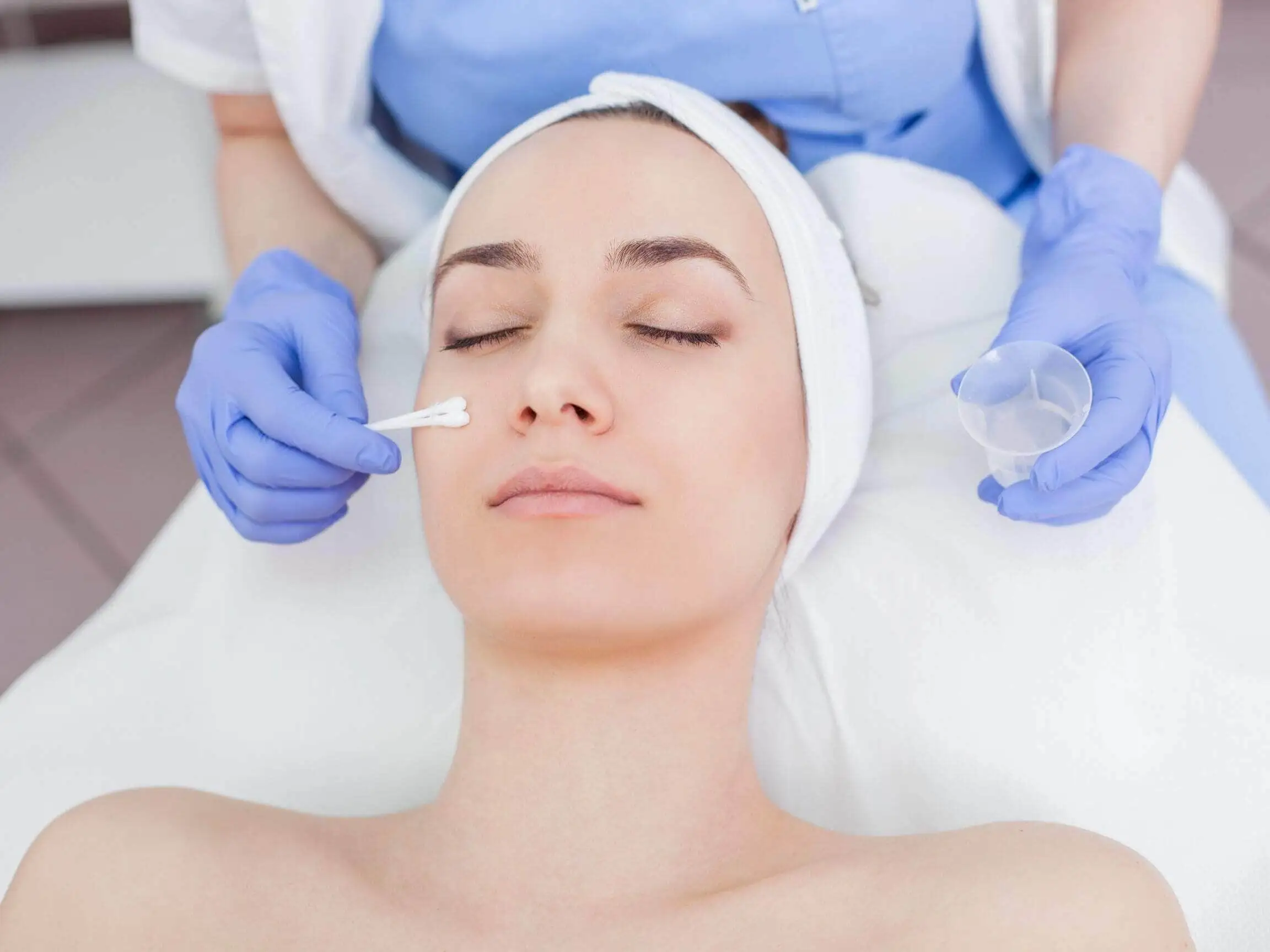 Glycopeeling arckezelés - a sav felvitele