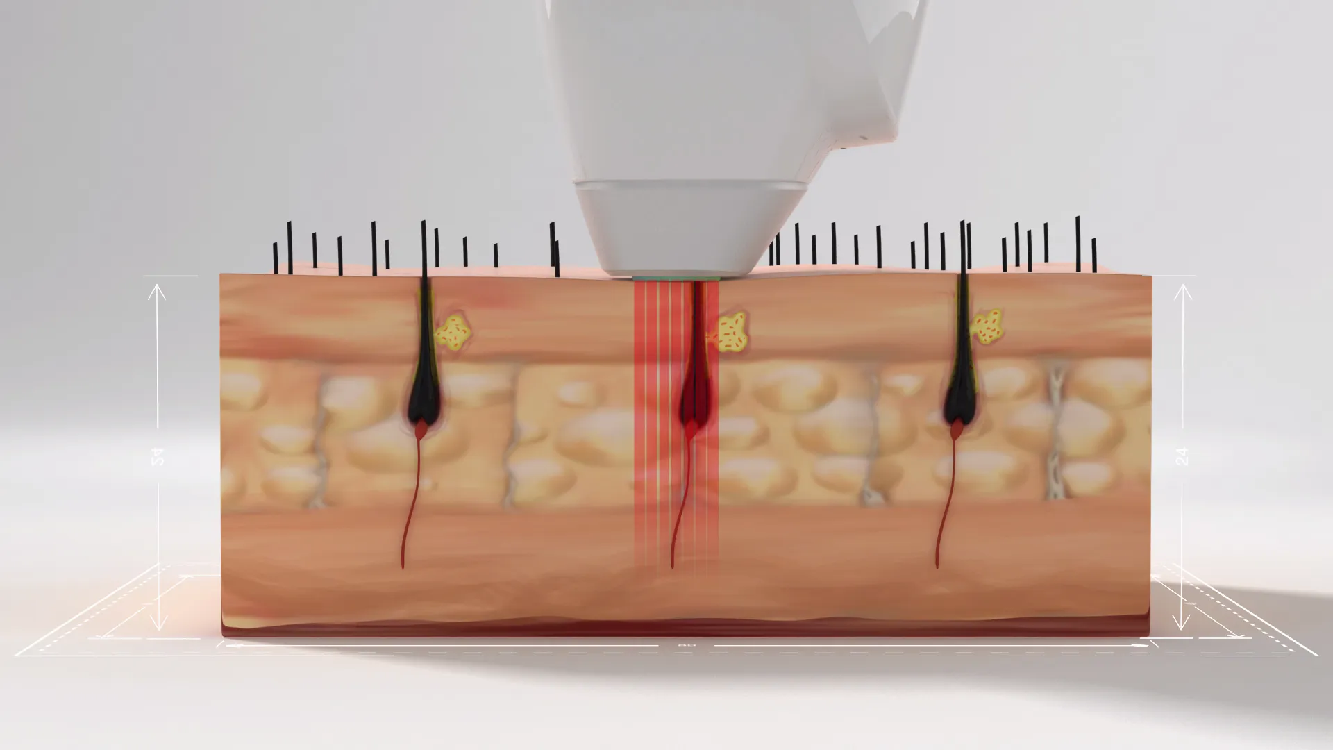 Diódalézer hatása a szőrtüszőkre