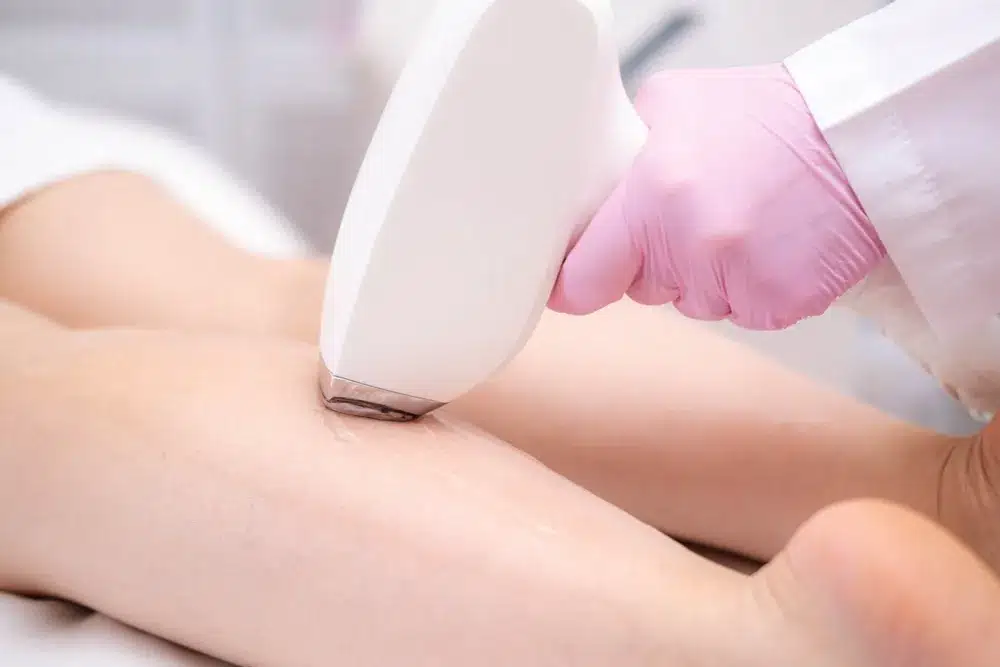 Női vádli diódalézeres szőrtelenítése