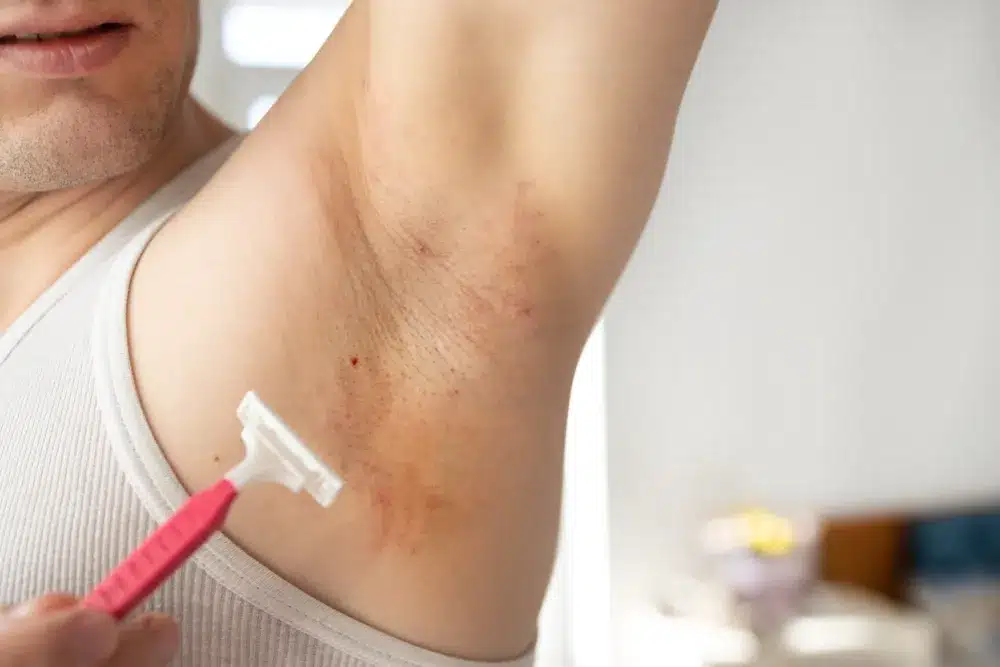 irritált férfi hónalj borotválkozás után